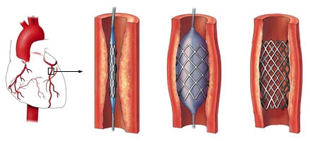 Cardiopatia ischemica cronica dureroasa